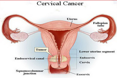 Cervical Cancer Specialist in Delhi