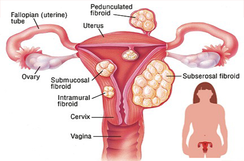 hysterectomy treatment in delhi