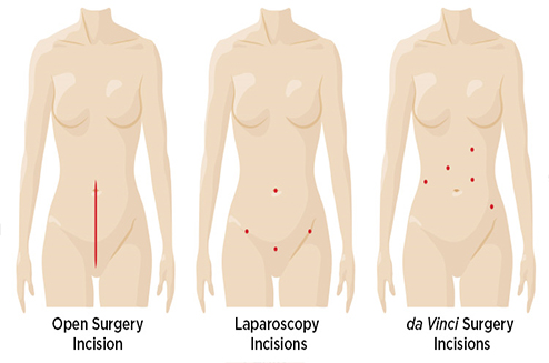 Robotic Gyneology in Delhi