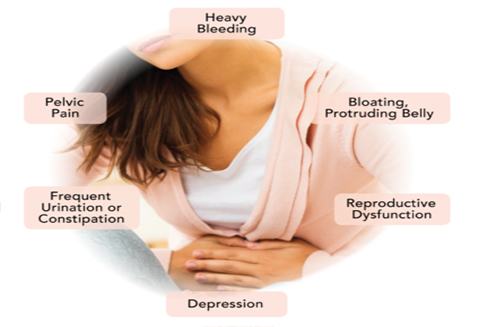 Fibroids Specialist in Delhi