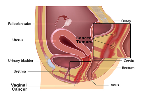 Vaginal cancer treatment in Delhi