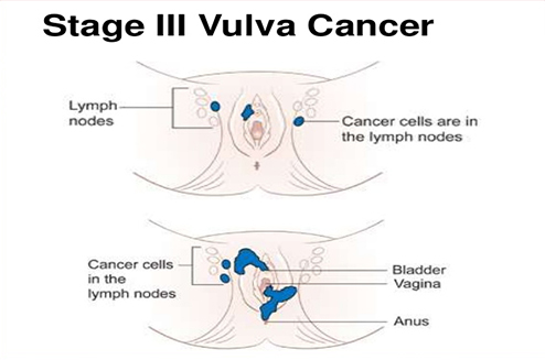Vulvar Cancer Specialist in Dehi